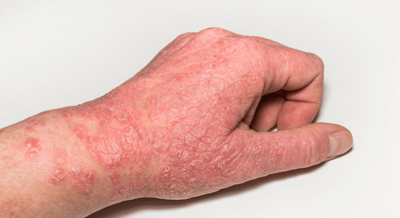 Eczema on Hands