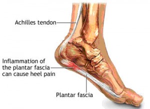 plantar_fascia